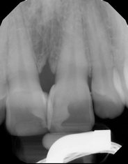 8 Post-operative radiograph. Note the resultant contours from the matrices, as well as the palatal volume at #8 due to the unusual positioning of the teeth.