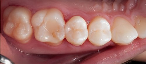 5 Scope photo. Note the unusual position of the matrices, due to the overlapping of the teeth