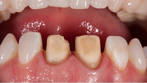 7 Immediate result following gingivectomy of #8 (11). Needs some refinement, which will be addressed after discussion with the periodontist.