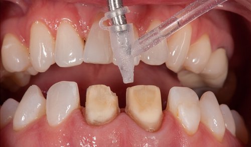 8 Post-operative radiograph. Note the resultant contours from the matrices, as well as the palatal volume at #8 due to the unusual positioning of the teeth.