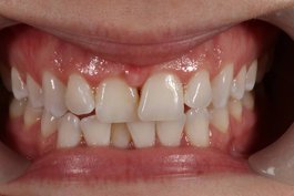 1 Initial frontal view,. Patient was unhappy with the black triangle between #8 and 9 (11 and 12)