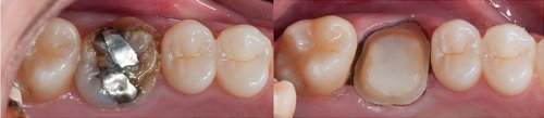 1 Initial frontal view,. Patient was unhappy with the black triangle between #8 and 9 (11 and 12)